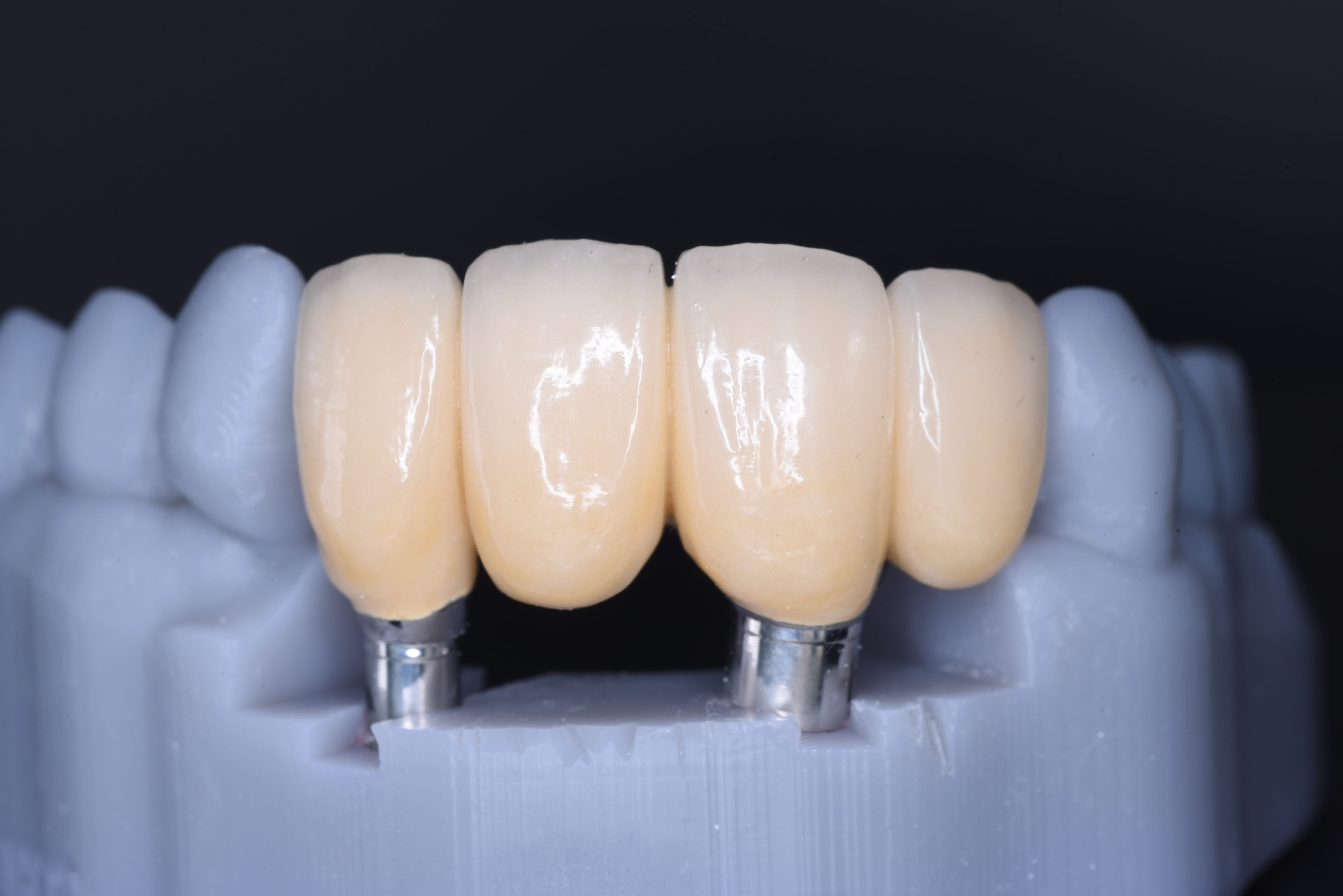 Implant-supported bridge on a 3D printed model