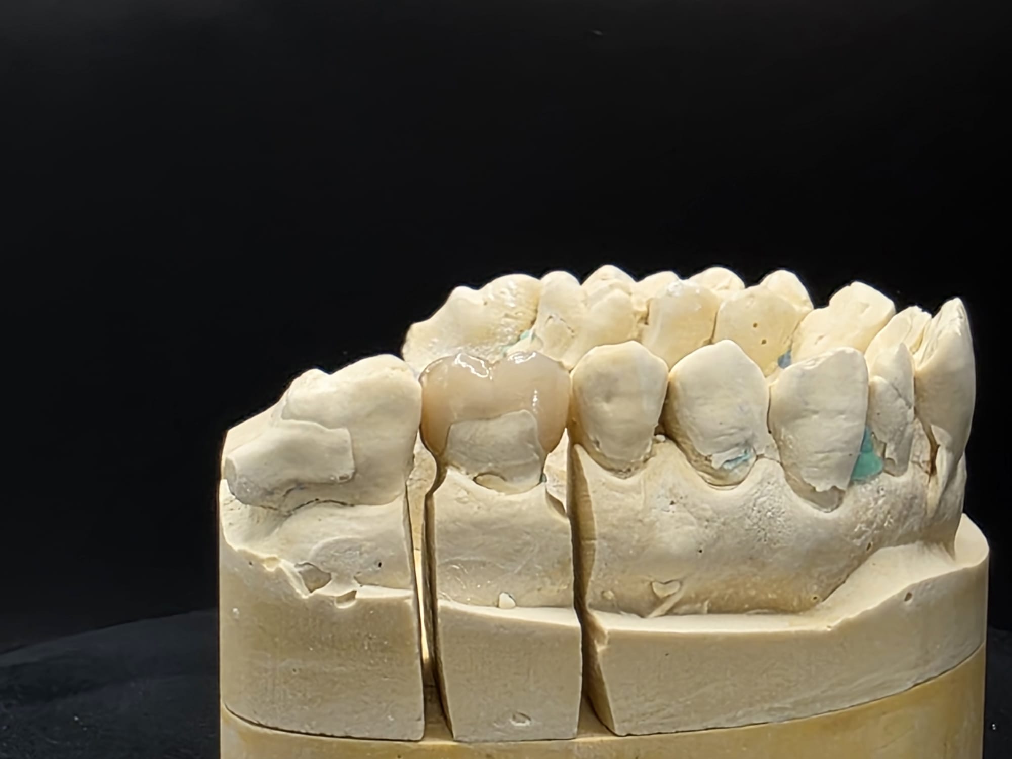 Finished crowns on a sectioned dental model