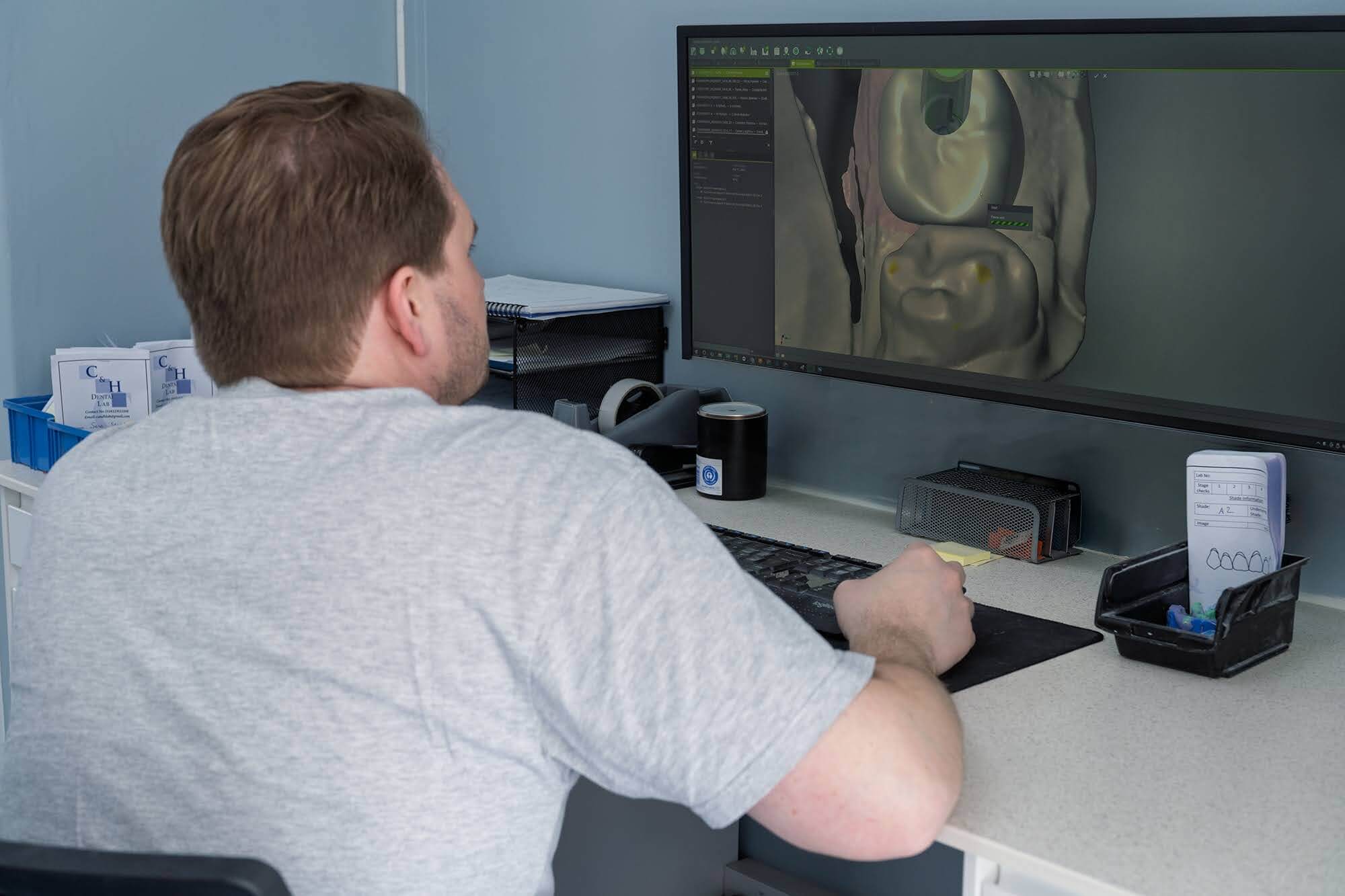 Digital implant restoration design in 3Shape Dental System