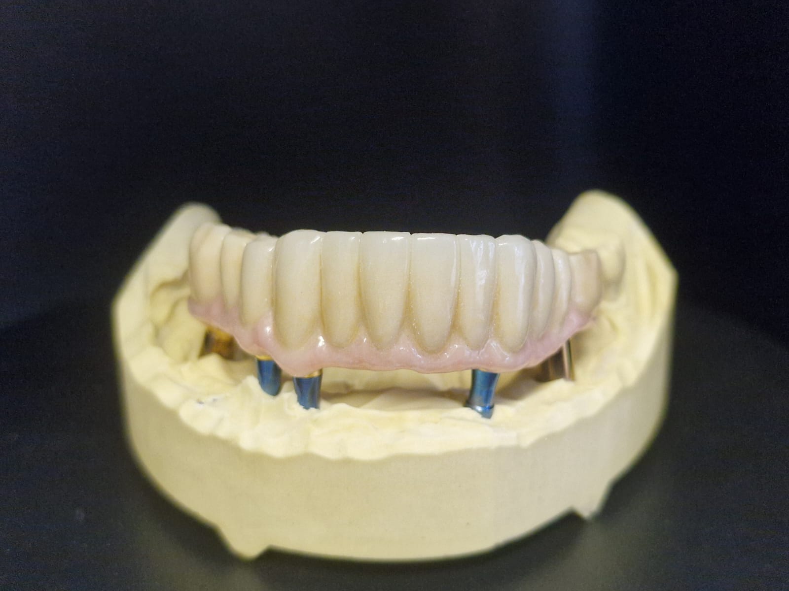 Full-arch implant-supported prosthesis on a dental model