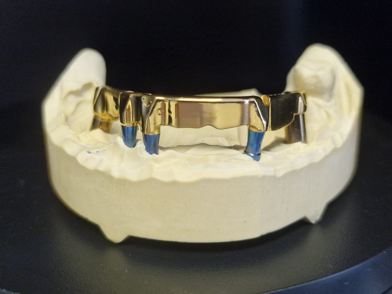 Polished gold framework seated on titanium abutments