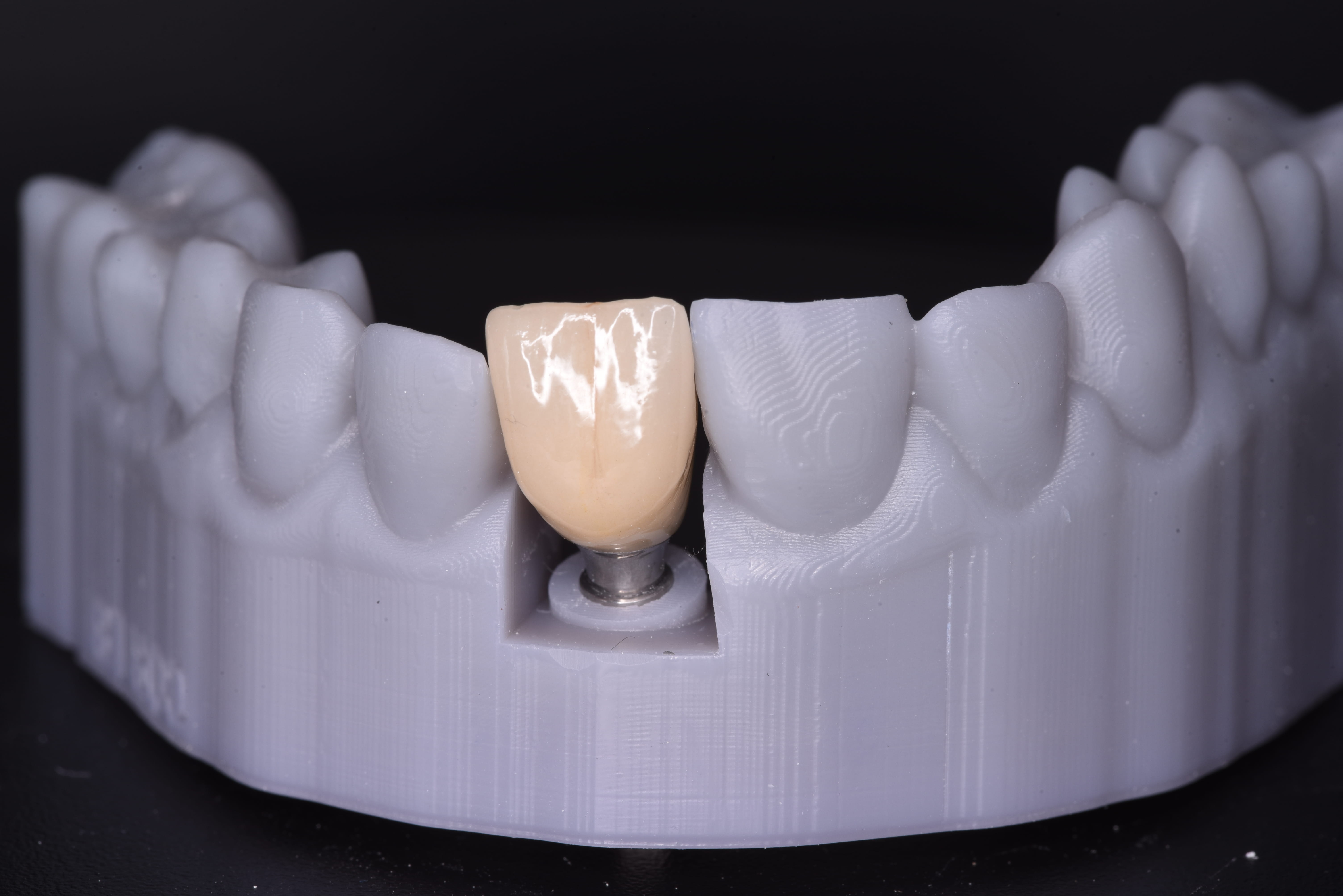 Implant crown seated on a 3D printed model showing abutment connection