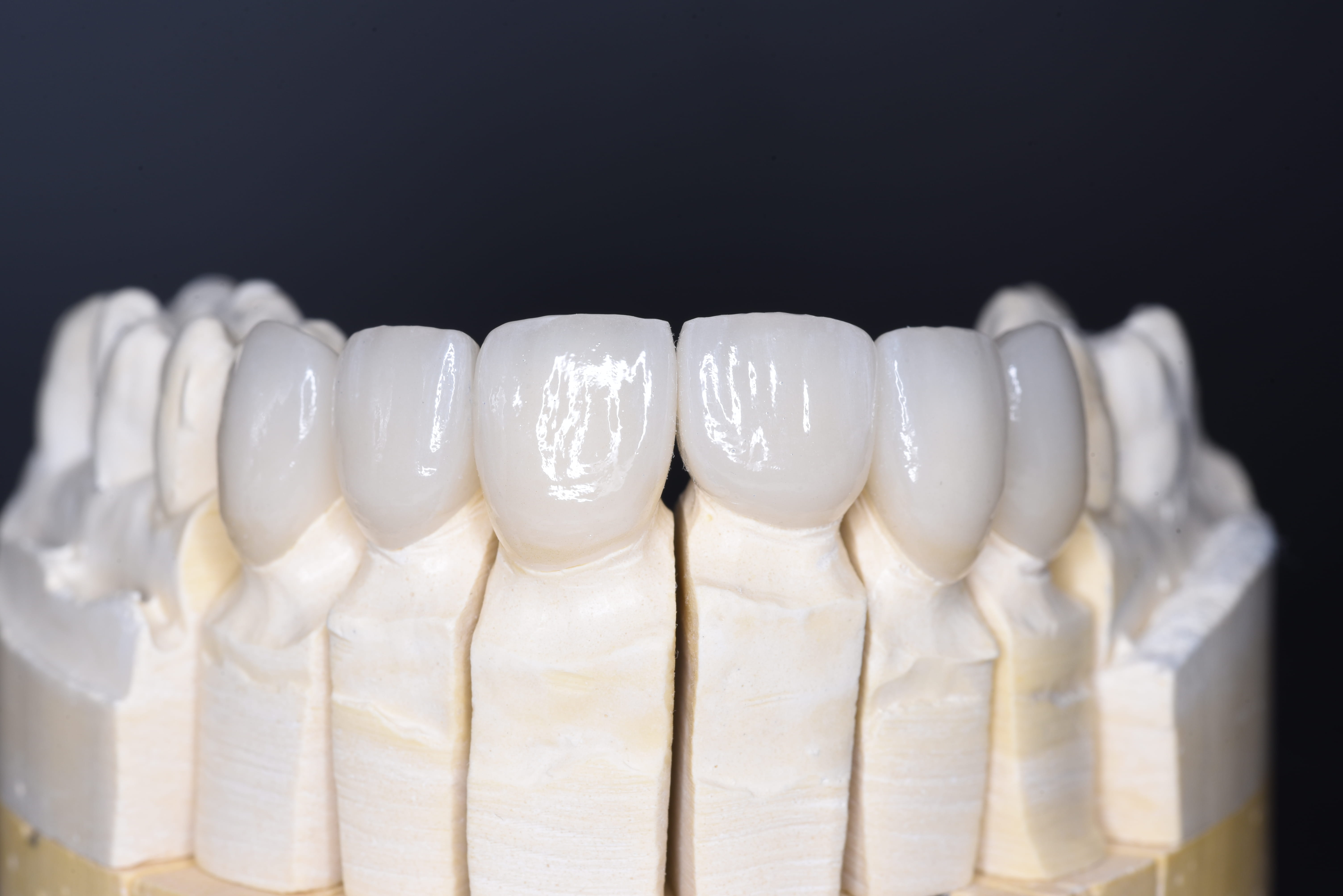 Layered ceramic crowns and veneers on a dental model